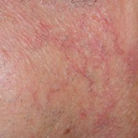 Couperose & rosacea – een gerichte aanpak