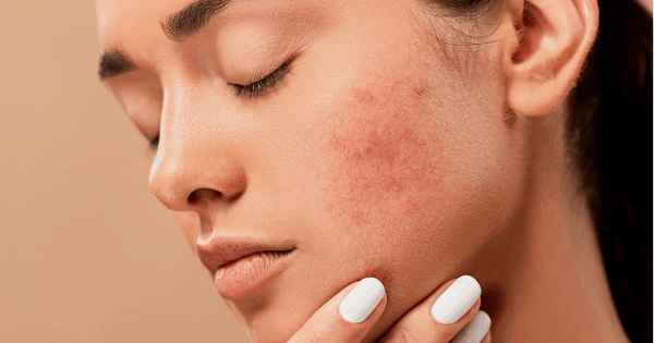skin issues